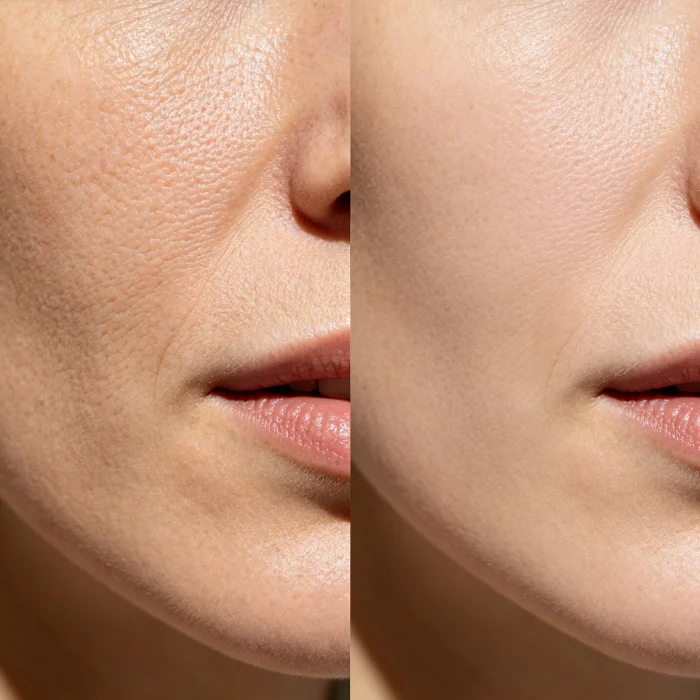 Close-up of a woman's skin texture before and after 8 weeks of red light therapy